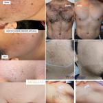 Professional Diode Laser Hair Removal Machine 808 755 940 For Beauty Salon
