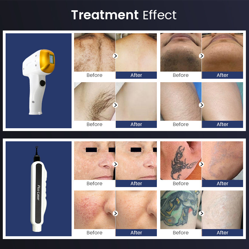 4 Wavelength Air Cooling Diode Laser Hair Removal + Nd Yag Picosecond Tattoo Removal Beauty Machine
