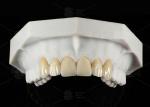 0.3mm-0.7mm Feldspathic EMAX Ceramic Veneers Natural Aesthetic Emax Dental