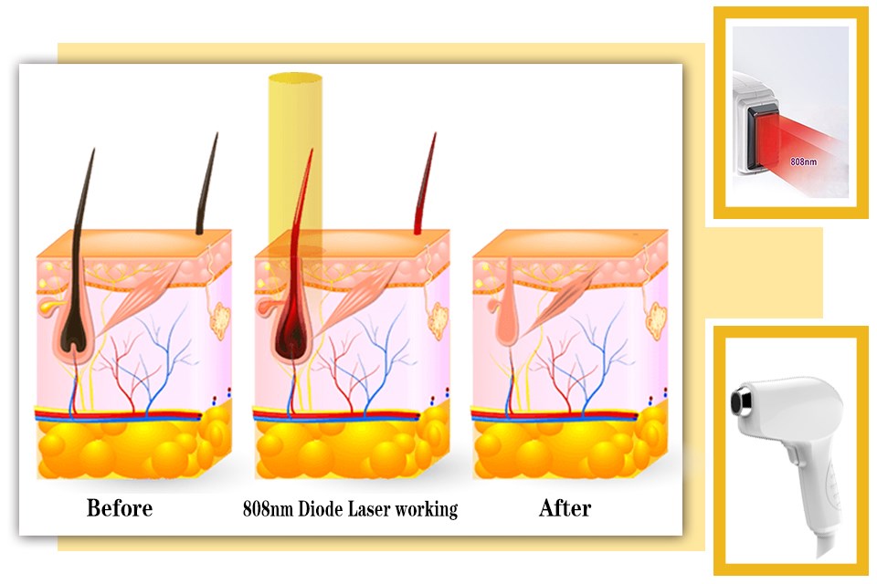 Self - Protection Diode Laser Hair Removal Machine With Semiconductor Cooling System