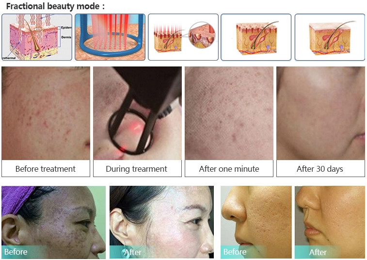 High Quality Fractional CO2 Laser scar removal beauty equipment