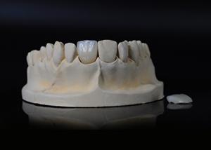 Wholesale Translucency Porcelain Emax Veneer for Excellent Fit / Natural Esthetics from china suppliers