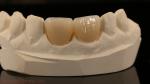Full Contour Zirconia Crown and High Aesthetic Natural Dental Bridge 5 Year