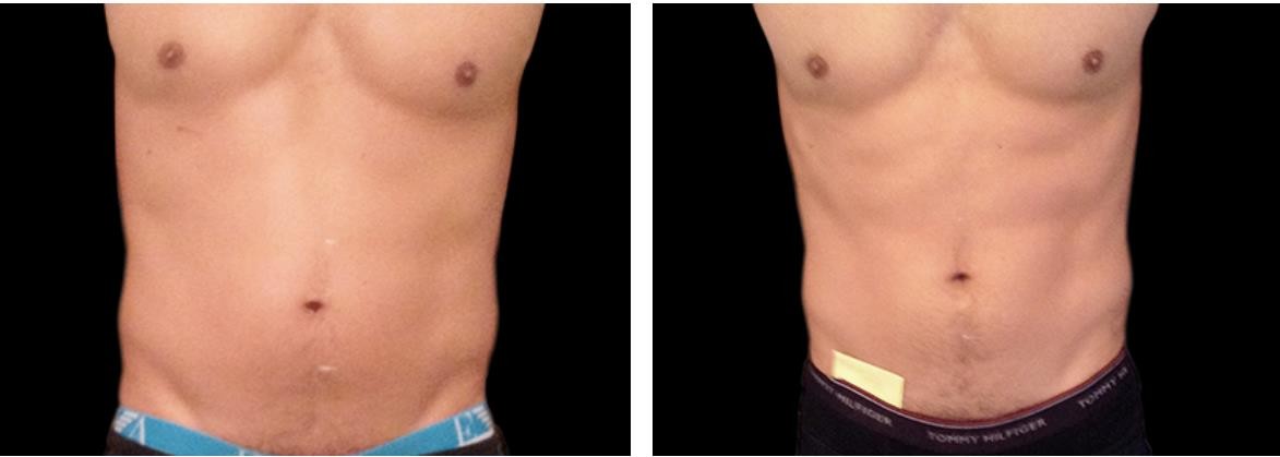 Ce Approved 7 Tesla Body Sculpting Machine
