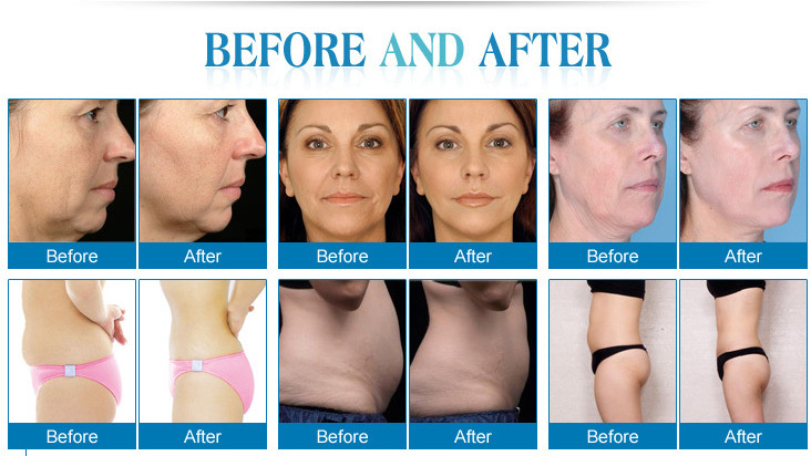 Face Lifting HIFU Beauty Machine High Intensity Vaginal Tightening Equipment