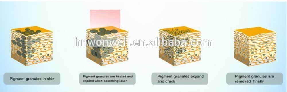protable Q.switch Nd.yag laser machine for tattoo removal