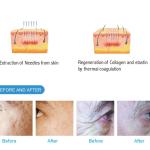 Professional Tip Pin 25pins 49 Pins Invasive Needle Free Skin Microneedle Rf