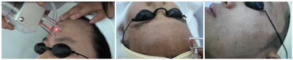 most popular vertical effective 30W USA fractional CO2 laser skin resurfacing /