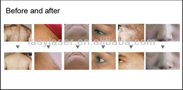 SHR IPL Portable Nd Yag Laser Tattoo Removal Depilation picosecond laser machine Laser Machine