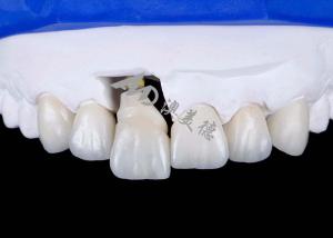 Wholesale Dental Implant Crown with Titanium Abutment For Natural Looking Smiles from china suppliers
