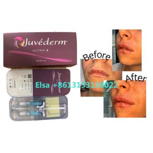 Wholesale Cosmetic Products Juvederm Dermal Filler For Face Lips from china suppliers