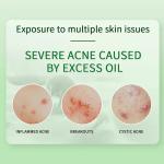 Deep Cleaning Anti-Acne Repair Fade Acne Mark Acne Treatment Cream