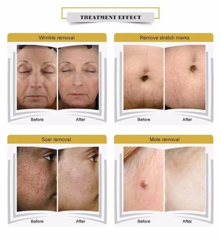 Acne Treatment Fractional CO2 Laser Equipment Anti Aging 10.6μm Wavelength