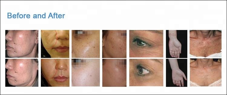 Portable Fractional CO2 Laser Machine 40W 10600nm For Skin Rejuvenation