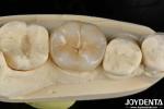 Adhesive Cementation Zirconia Dental Inlays And Onlays Natural Looking
