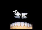 Translucencys IPS Emax Veneers , Minimal Preparation Emax Dental Veneers