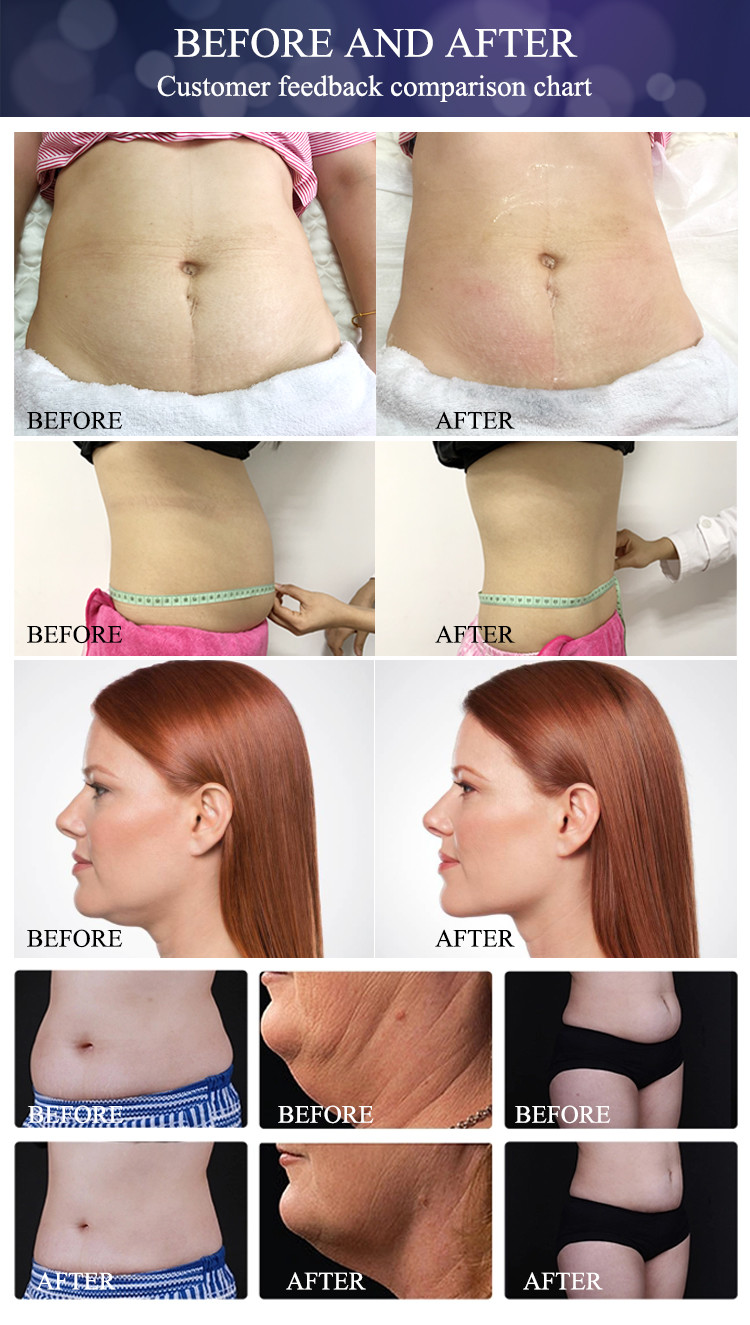2020 New technology cryotherapy cryolipolysis body shaper slimming weight loss extracorporeal shock wave therapy equipme