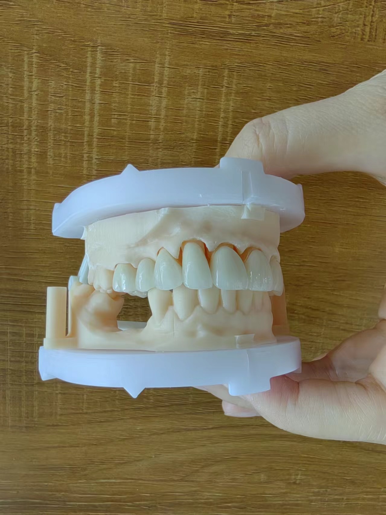 Durable Zirconia Layered With Porcelain Zirconia Multilayer Crown