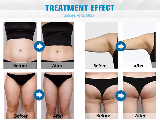 27.12MHz Body Slimming Machine Vibration Cavitation Fat Loss