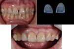 0.5mm Thickness Ceramic Dental Veneers Natural Looking For Anterior Tooth
