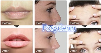 Women Face Hyaluronic Acid Skin Injections Cross Linked In Transparent Color