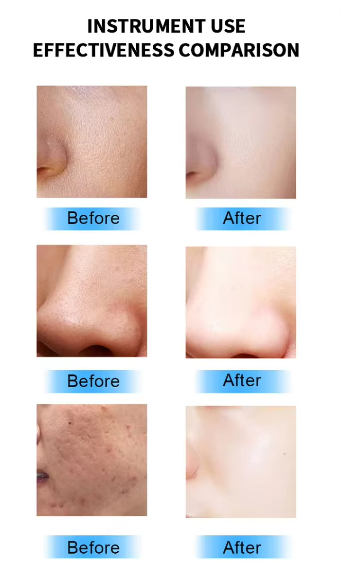 Skin Tightening Acne Treatment Fractional RF Gold Microneedling Device