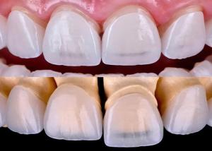 Wholesale Long Lasting Dental EMAX Veneer Fabricated With All Ceramic Zirconium Material from china suppliers