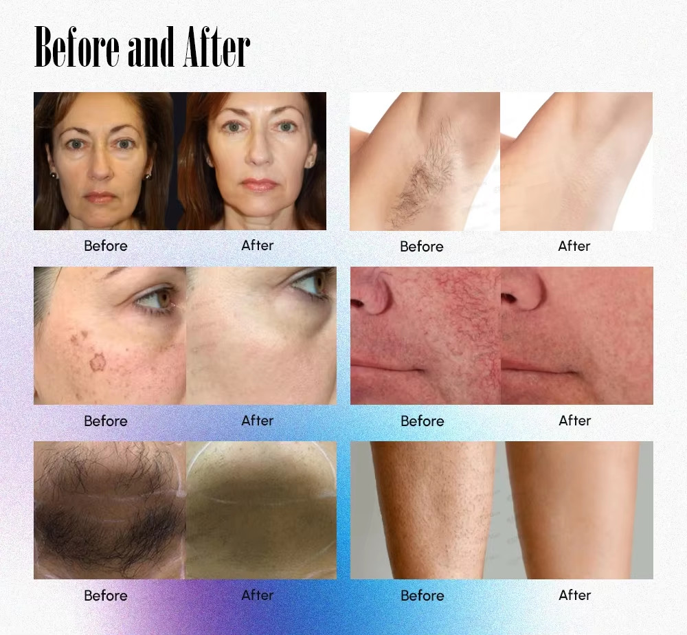 755nm 1604nm Nd Yag ALEX Laser Long Pluse Hair Removal Machine