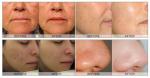 Multifunction Diamond Hydro Microdermabrasion Machine Non Surgical for Facial