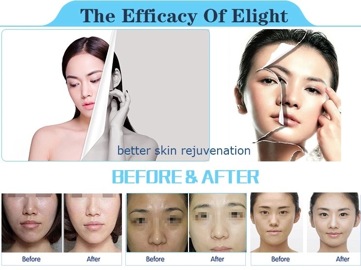 CE approved three handles ipl hair removal machine nubway manufacturer ipl hair removal equipment