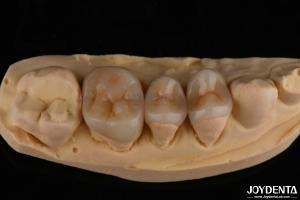 Wholesale Natural Looking Emax Inlay Onlay Long Lasting Dental Restoration 0.5mm 1mm 1.5mm Thick from china suppliers