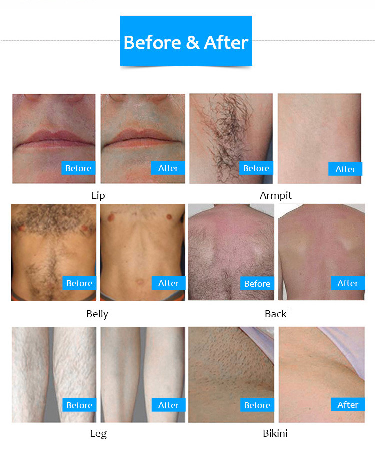 Vertical Ipl Wavelength 640nm Opt Hair Removal Machine