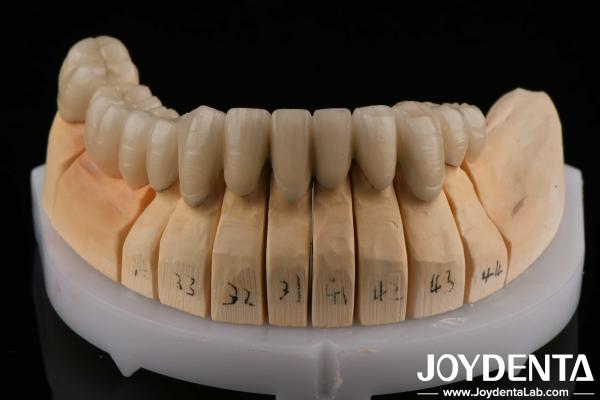 Gold Alloy PFM Porcelain Fused to Metal Dental Compatible With Porcelain
