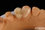 Emax Maryland Veneer Clinical Bonding Adhesion For Color Matching Dental Repair