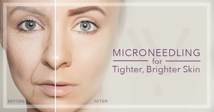 2 In 1 Fractional Rf Microneedle Machine Adjustable Depth Of Needle