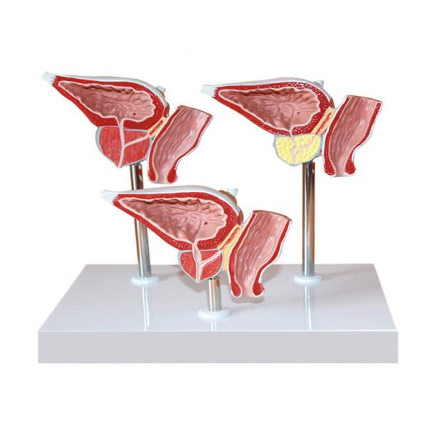 Human Anatomy PVC Simulation Human Pathology Prostate Model For Medical