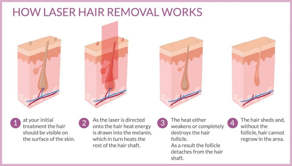 Diode Laser Beauty Equipment 755 808 1064 Hair Removal Skin Rejuvenation