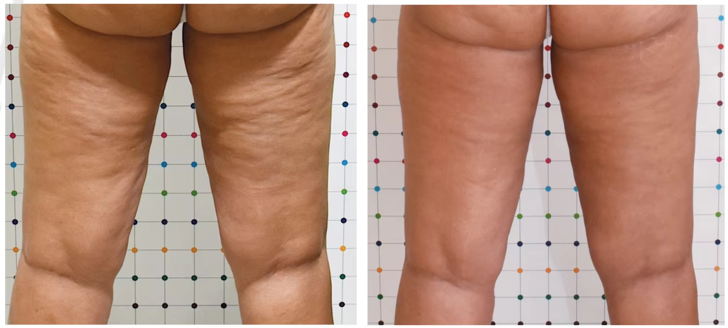 Fat Cells Remove Body Slimming Coolwaves Cellulite Removal Machine