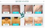competitive price women underarm 755nm 808nm 1064nm laser hair removal machine