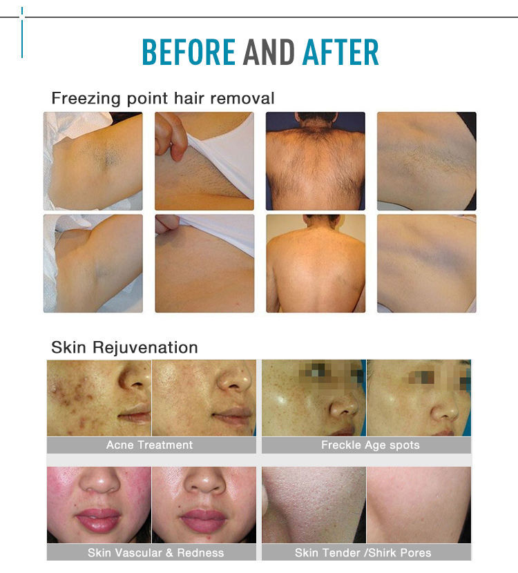 Permanent OPT E Light SHR IPL Laser Hair Removal Machine 1-10 Pulses