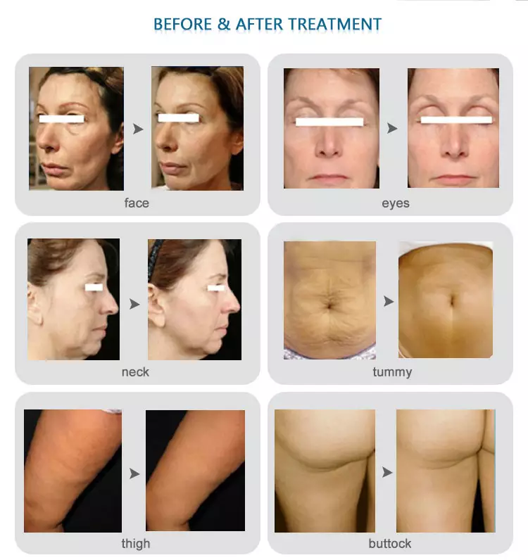 Distributing fractional rf microneedling machine for skin tightening face neck lifting