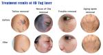 300W YAG IPL Diode Laser Device For Eyebrow Removal Carbon Peeling
