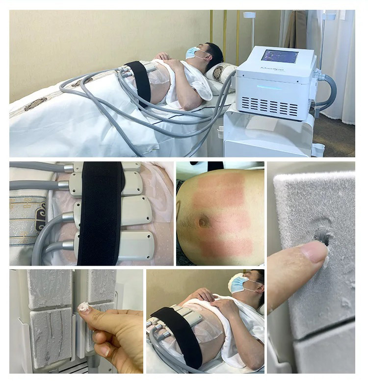 Cryo Slimming Ems Plates Muscle Stimulator Body Sculpting Machine