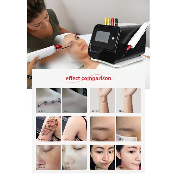 100-200MJ Laser Pigmentation Machine , Upgraded Mini Picosecond Laser Machine