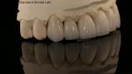 Full Contour Zirconia Crown and High Aesthetic Natural Dental Bridge 5 Year