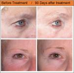 Hifu Face lifting Beauty mahcine/ hifu Face Lifting/ hifu hifu 05 face lifting
