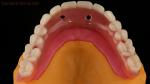 Acrylic Partial Implant Over Denture Titianium Bar Full Denture Teeth Set Up