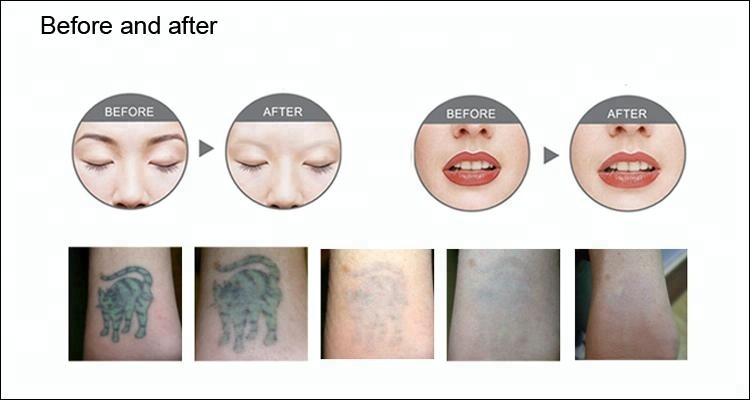 OEM / ODM Q Switch Yag Laser Tattoo Removal Machine 2 Years Warranty