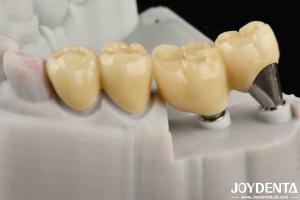 Wholesale Natural-looking Implant Crown And Bridge Safe For Oral Long Lasting Performance from china suppliers