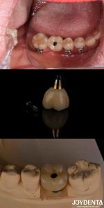 Wholesale 4-6 Dental Endosseous Tapered Implant Subcrestal Bone Level And Internal Hex Connection from china suppliers